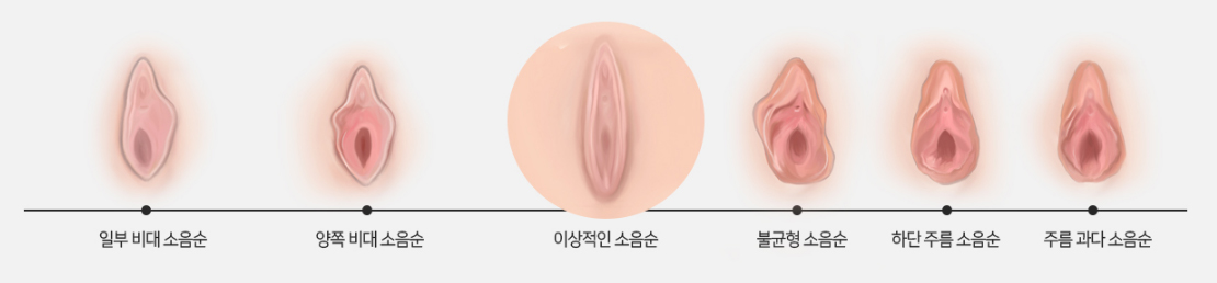 수술이 필요한 소음순 모양