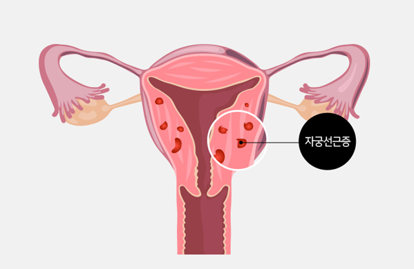 자궁선근증이란?