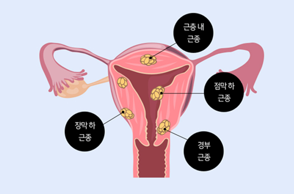 자궁근종이란?